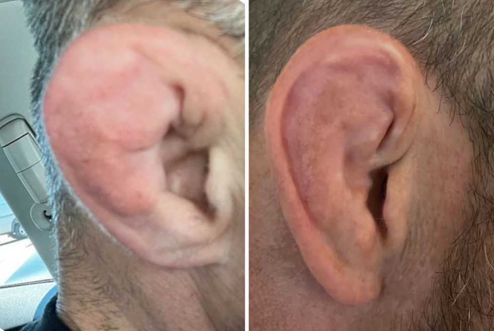 cauliflower-ear-jiu-jitsu-medicine